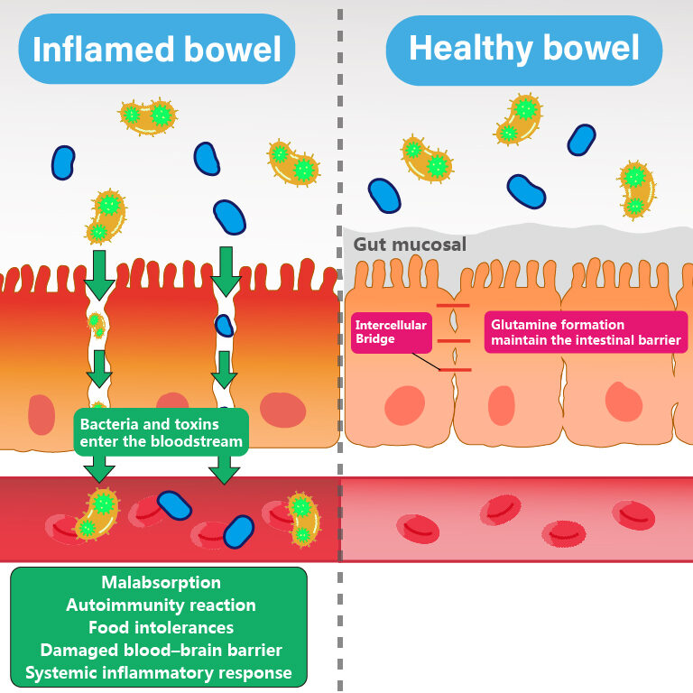Leaky Gut-Cause and Prevention-inflamed bowel-healthy bowel