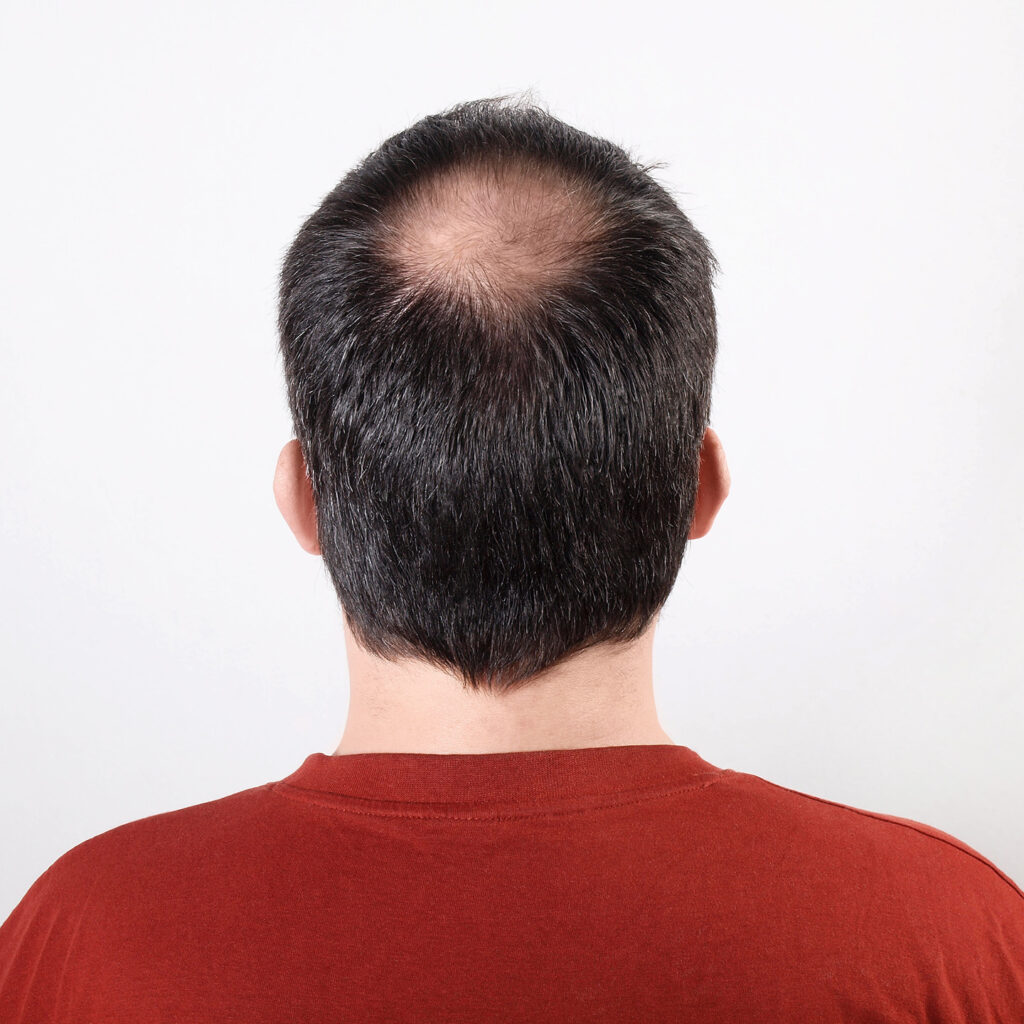 back-of-male-head-with-thinning-hair-or-alopecia-o-2021-09-01-10-31-15-utc
